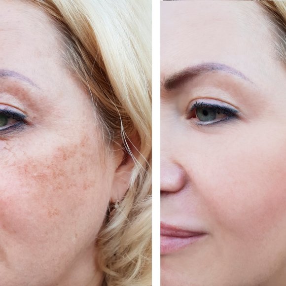 TCA Peel 20% Fine Lines, Dark Spots, Crepey Skin - Picture 4 of 6